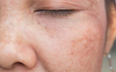 Sinais do envelhecimento da pele