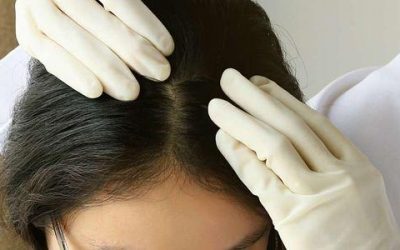 Couro cabeludo seco: o que fazer?